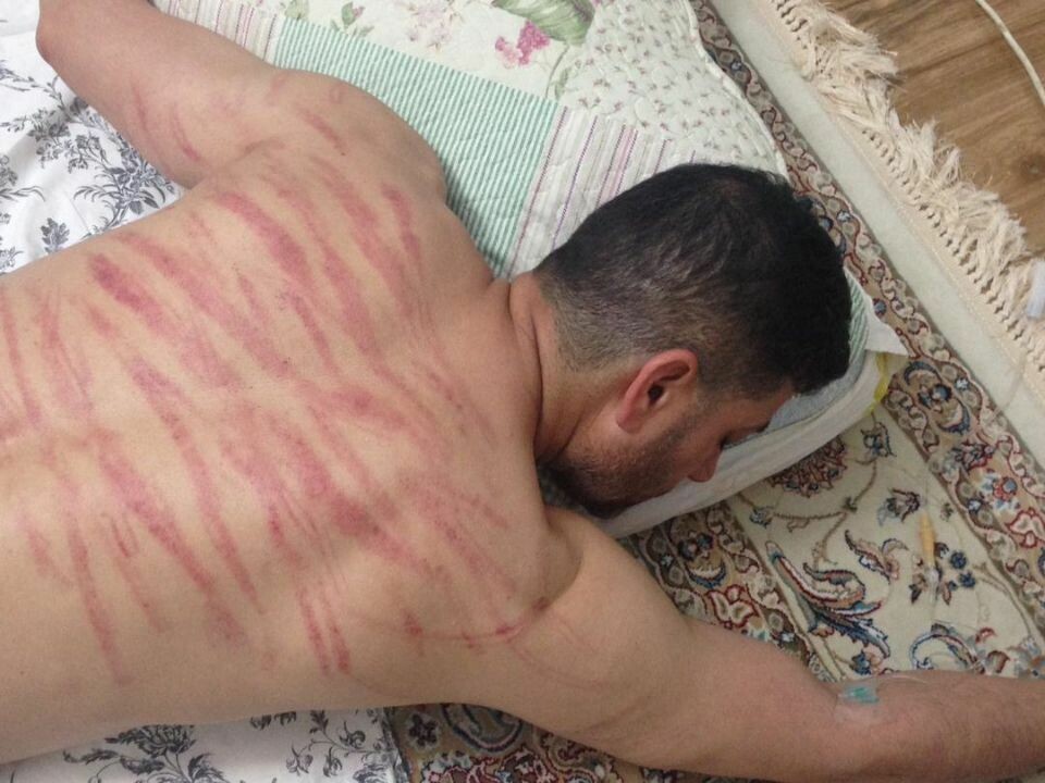 Sorab Abolfathi fotografert med tydelige merker på ryggen. 45-åringen forteller at han ble pisket og slått etter å ha blitt tvangssendt fra Norge til Iran. Foto: Privat