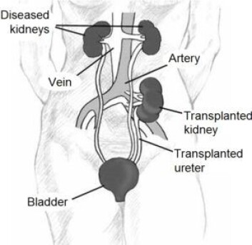 Ved nyretransplantasjon blir vanligvis ikke de gamle nyrene fjernet, men den friske nyra blir koblet på systemet. Den vil overta arbeidet med å fjerne avfall og overflødig væske fra blodet. Illustrasjon: Wikipedia Ved nyretransplantasjon blir vanligvis ikke de gamle nyrene fjernet, men den friske nyra blir koblet på systemet. Den vil overta arbeidet med å fjerne avfall og overflødig væske fra blodet. Illustrasjon: Wikipedia